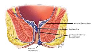 Hemorrhoid Symptoms illustration showing internal and external hemorrhoids
