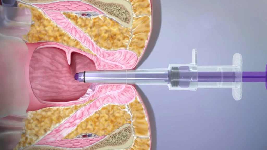 CRH O’Regan System Hemorrhoid Treatment procedure image